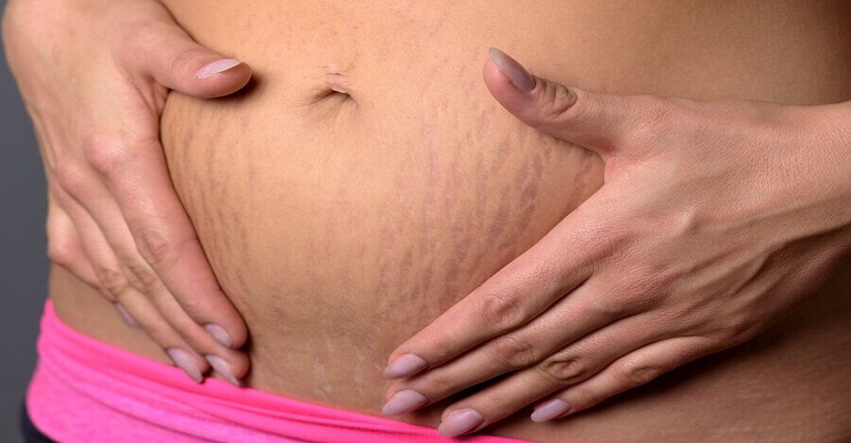 Como eliminar as estrias após a gravidez