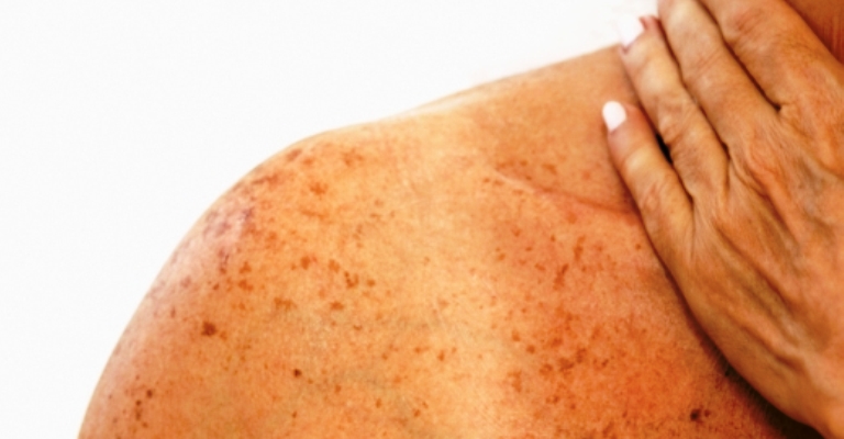 Dezembro Laranja alerta para o câncer de pele