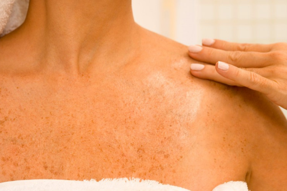 O verão está chegando: proteja-se para prevenir o câncer de pele