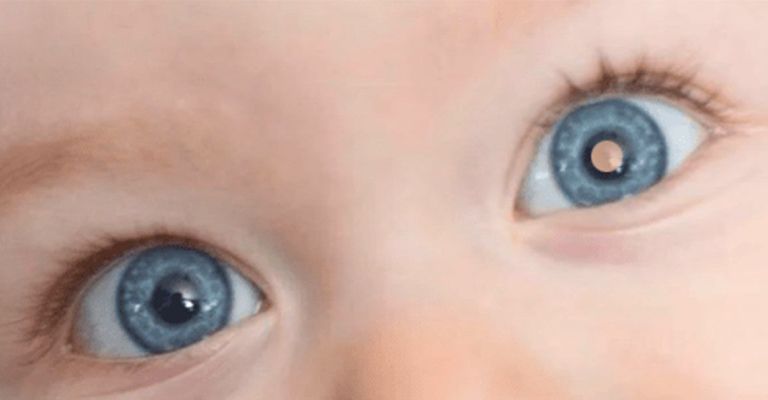 Reflexo esbranquiçado no olho é o principal sinal do retinoblastoma